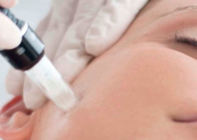 Dermapen (Microneedling)