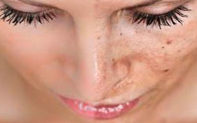 Tratamiento de Cicatrices