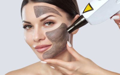 Láser con Carbono Activo